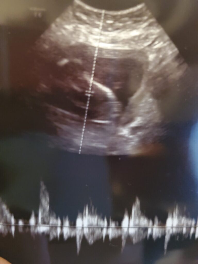 marylee hernandez tubal reversal baby pregnancy ultrasound