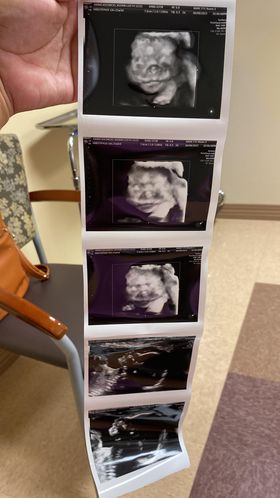 ultrasound photos of keerin deras' tubal reversal baby boy due october 2023