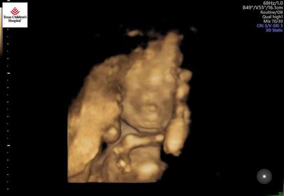 ultrasound of lacey hartman's 2nd tubal reversal baby